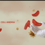 Nigeria accounts for over 1.5 million children with sickle cell disease, highest in the world, new Lancet study shows